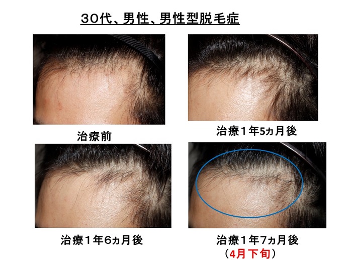 円形脱毛症　病院